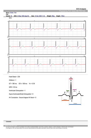 Exercise ECG Analysis