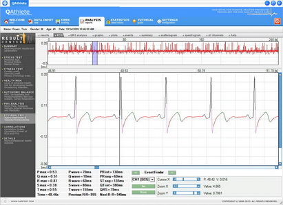 Exercise ECG Analysis